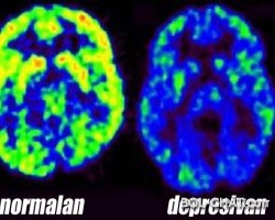 Što depresija radi vašem mozgu i kako je se riješiti?