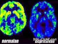 What depression works for your brain and how is it resolved?